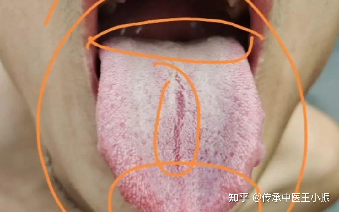 舌头中间有裂纹,是脾虚还是肾虚呢? - 知乎