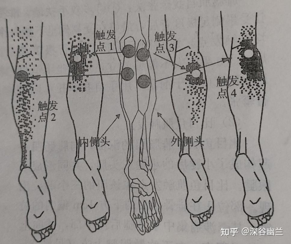 腓腸肌內側頭的觸發點有四個,都在脛骨的後上段.