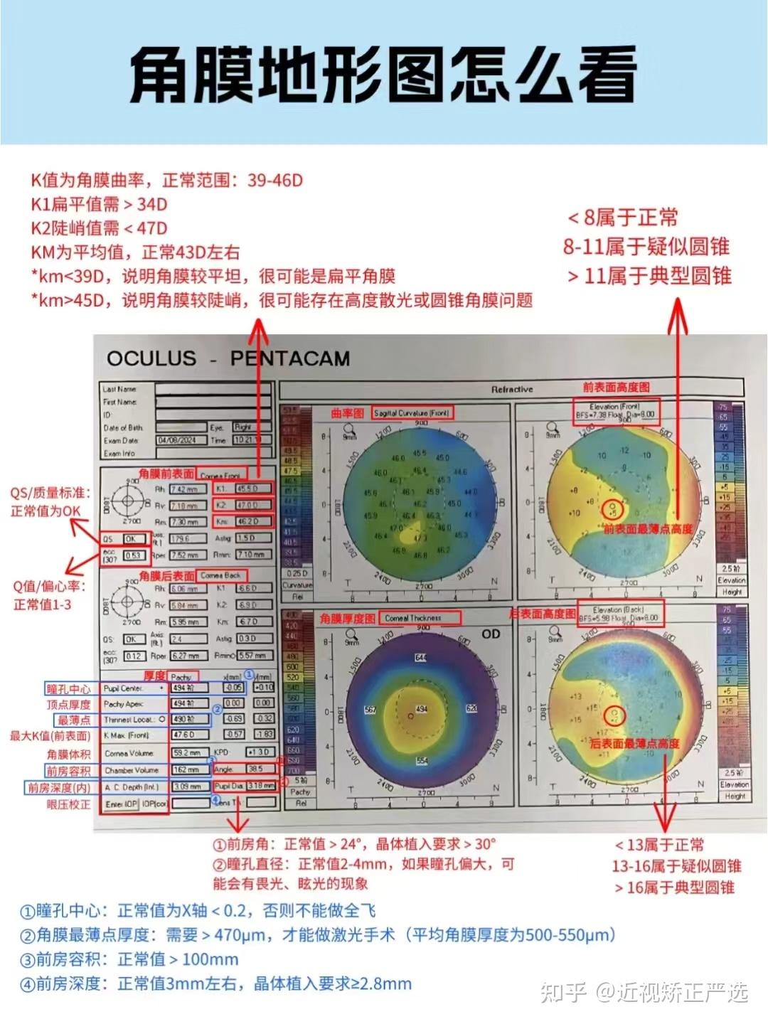 角膜地形图怎么看