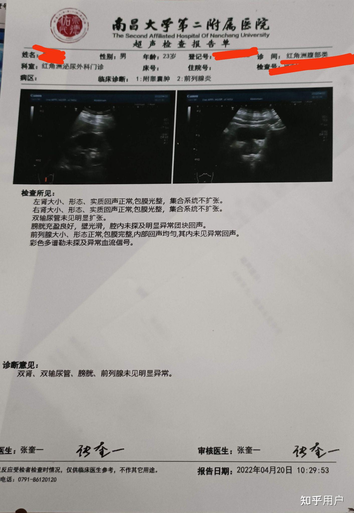 睾丸附睾囊肿