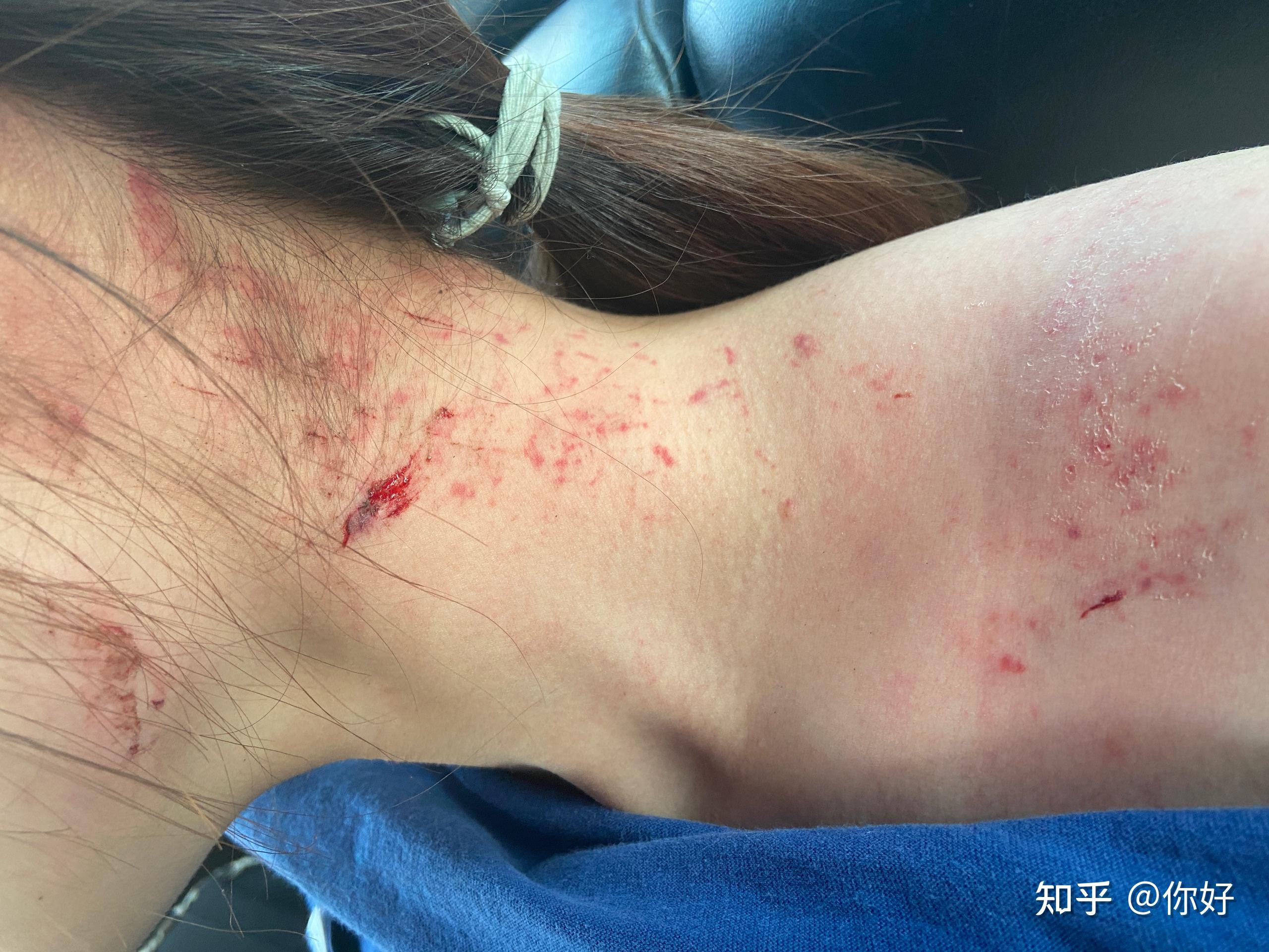 求助脖子下巴擦伤要怎么修复不留疤啊qaq