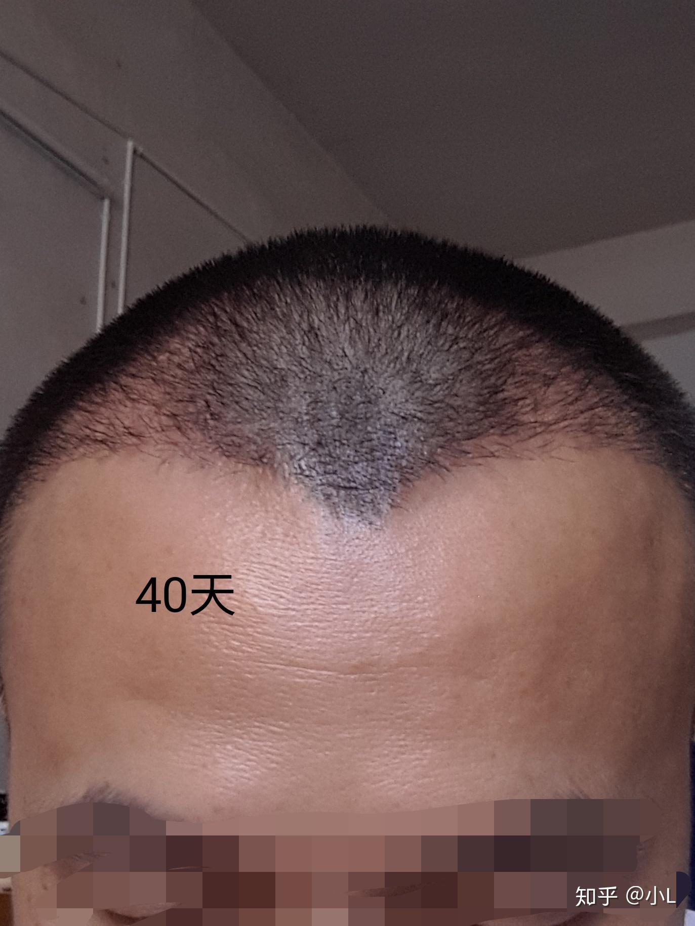 有些发友想知道我现在恢复的怎么样了,在这我给发友们介绍一下我植发