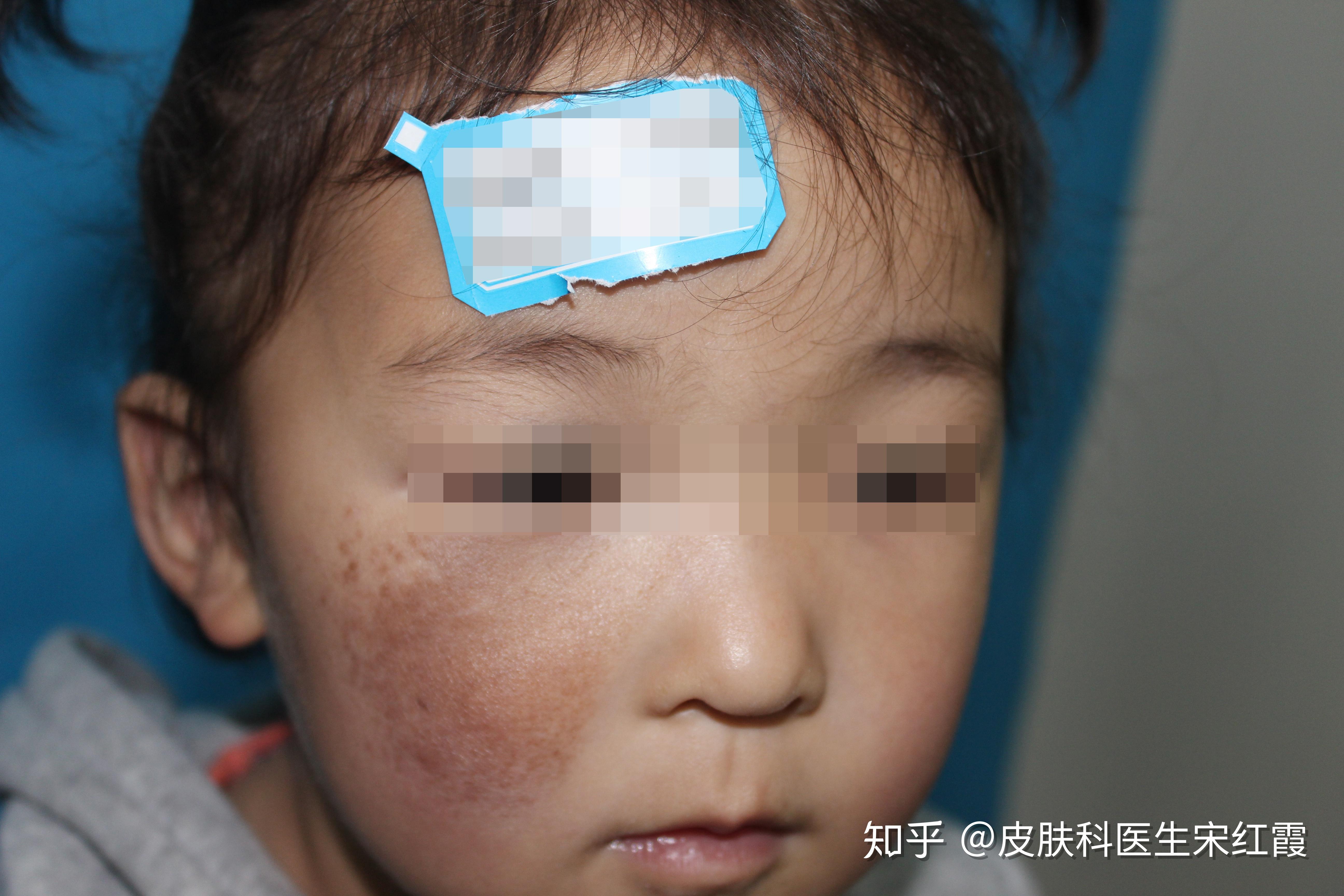 新生儿胎记可以慢慢消退吗