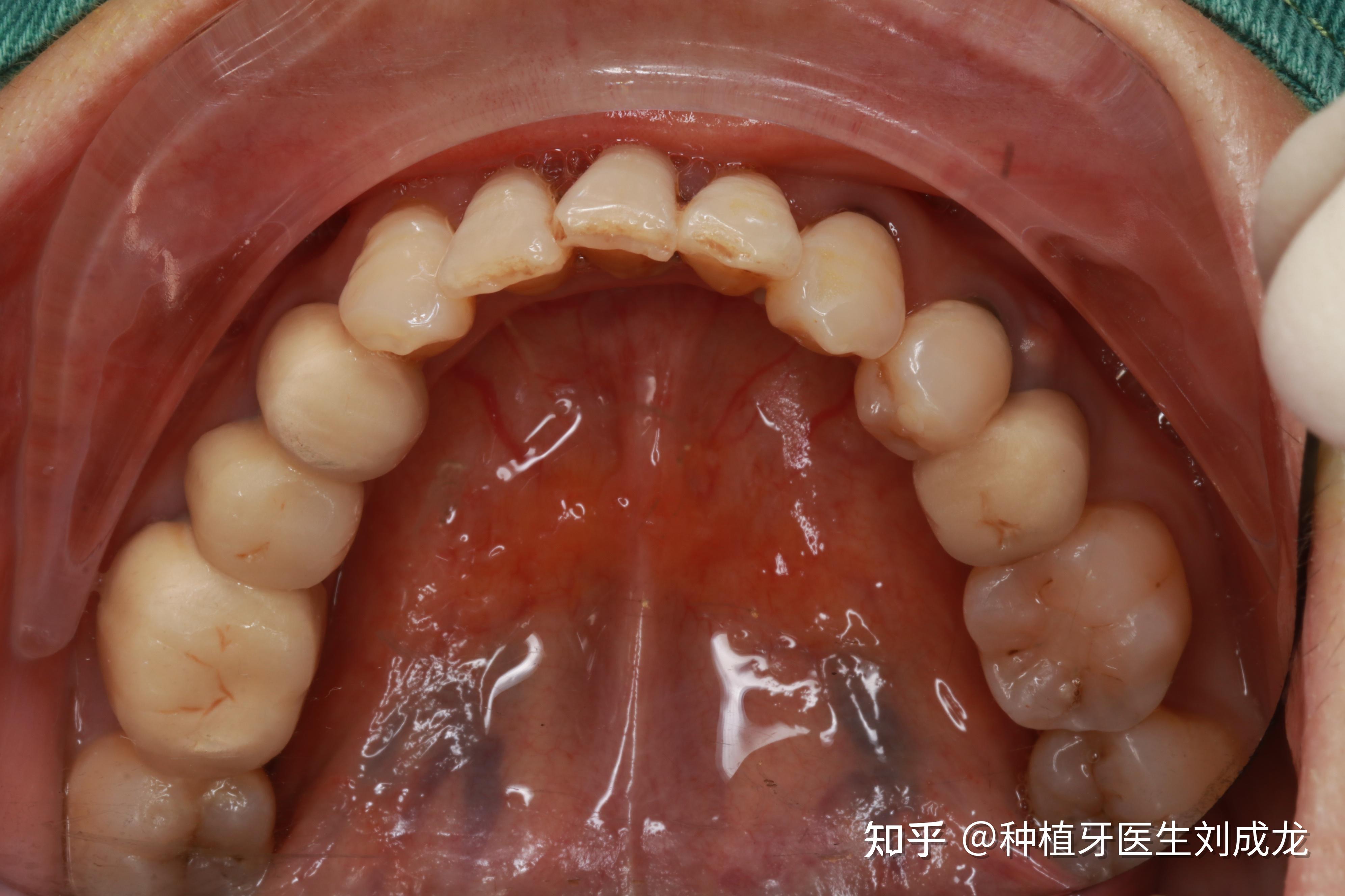 郑州种植牙医生刘成龙上颌磨牙区单颗种植案例