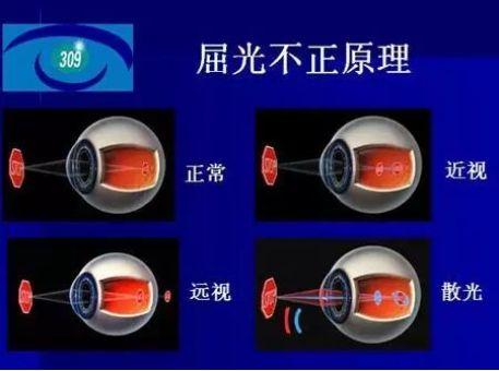 你了解近视和散光的区别吗？ - 知乎