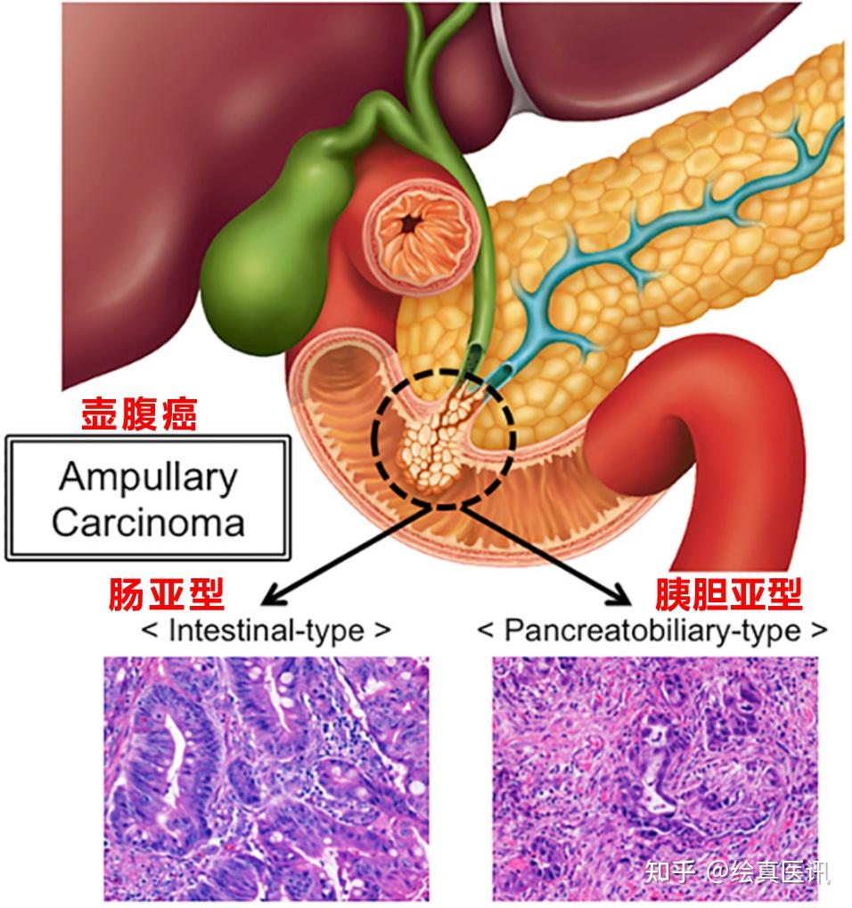 胆胰壶腹图片