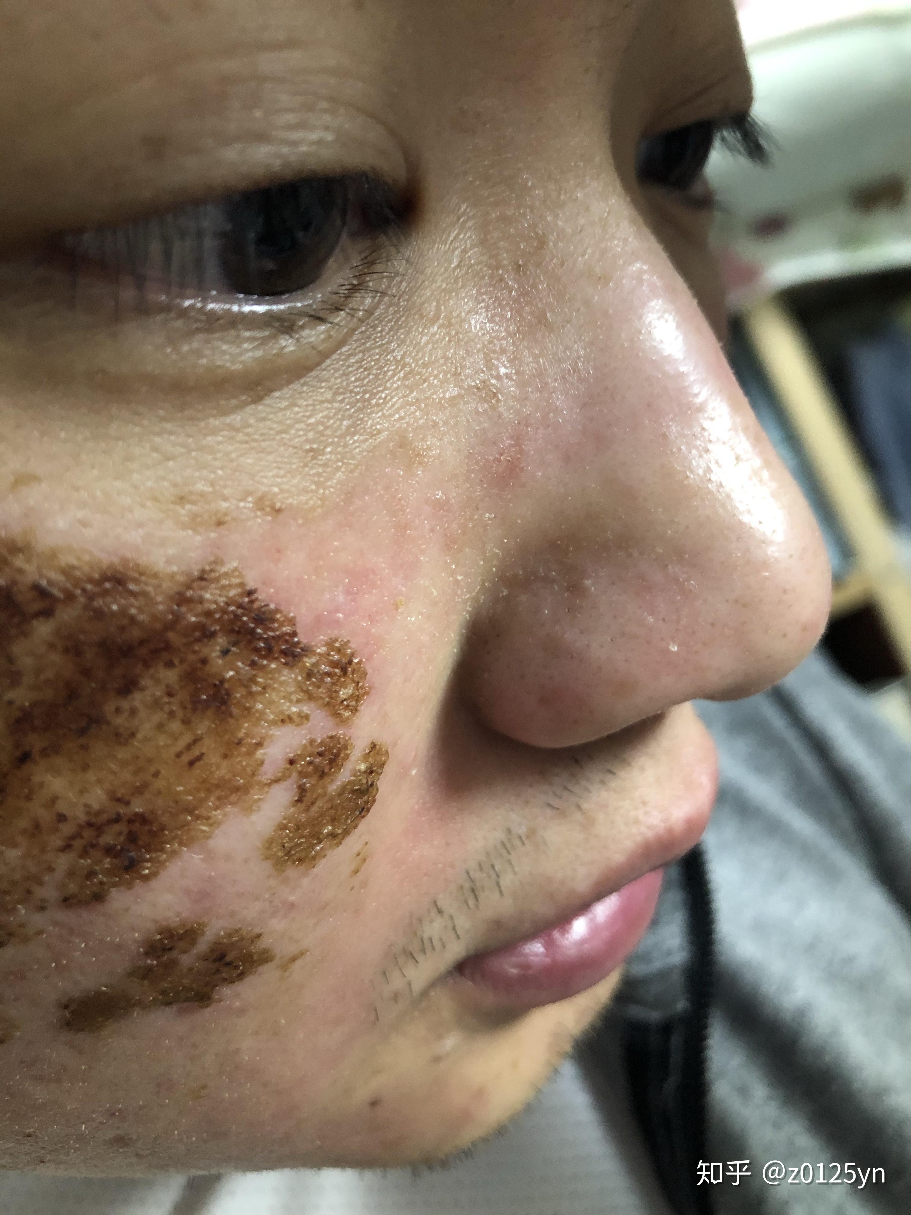 记录男朋友点阵激光的历程