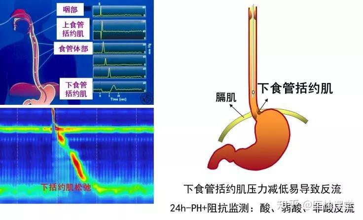 胃食管反流病怎么治，看这篇就够了！ - 知乎