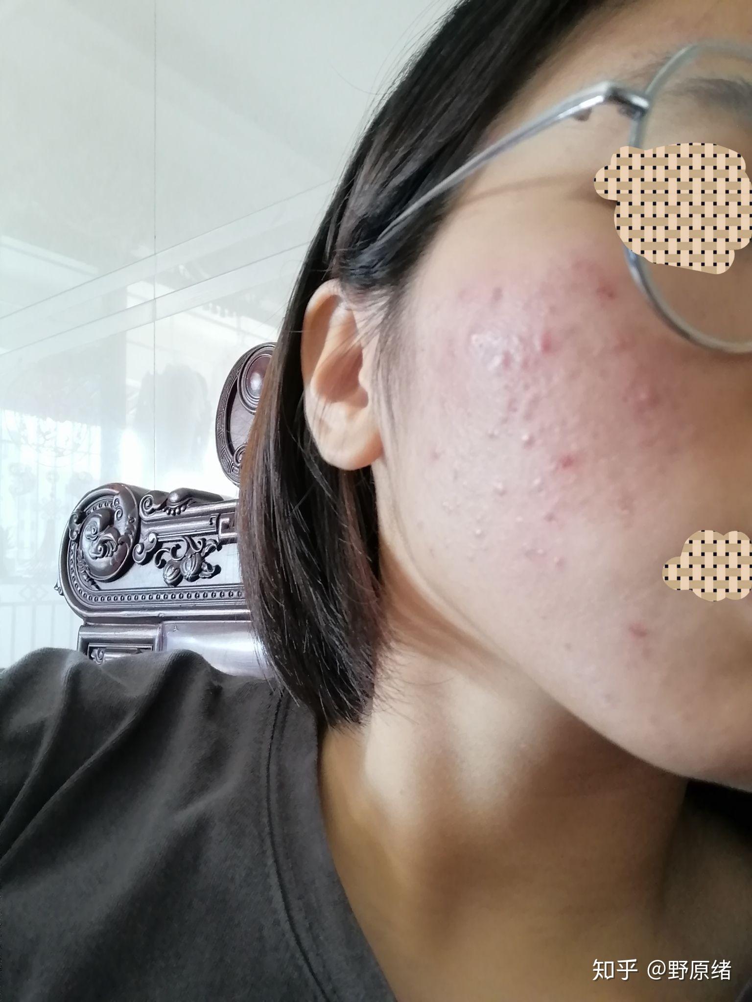 周围以前长过粉刺 不知道为什么自己消失不见了  这几天涂阿达帕林