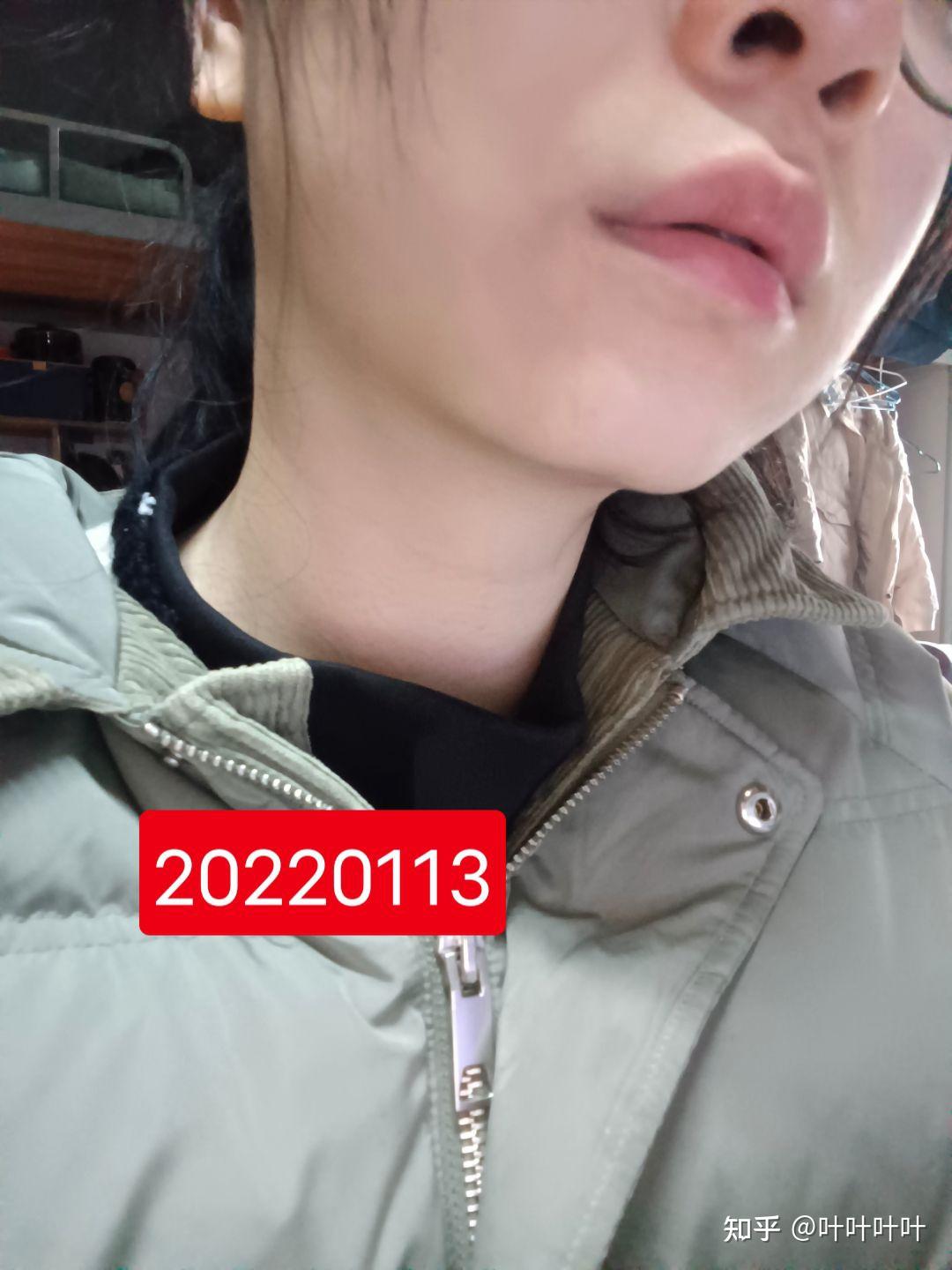 什么不能吃什么(这个病是先天性的,其实什么都能吃,手术恢复以后也是