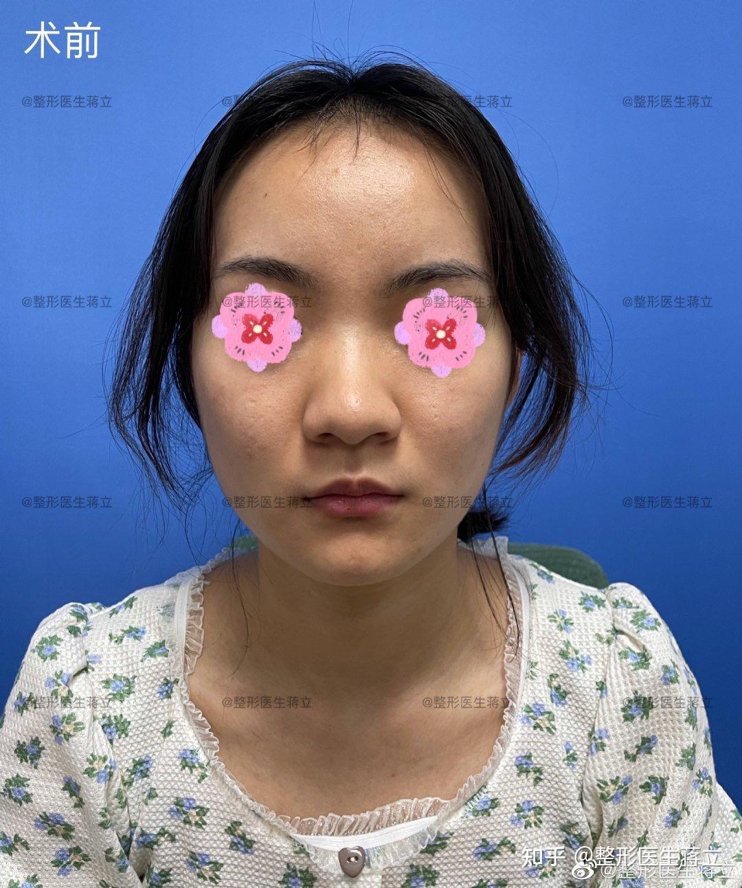 鼻中隔偏曲,鼻梁塌,鼻基底凹陷,面中凹陷【大鼻头