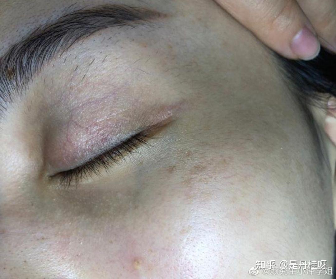 20岁左右的女生眼睛周围长斑什么原因啊