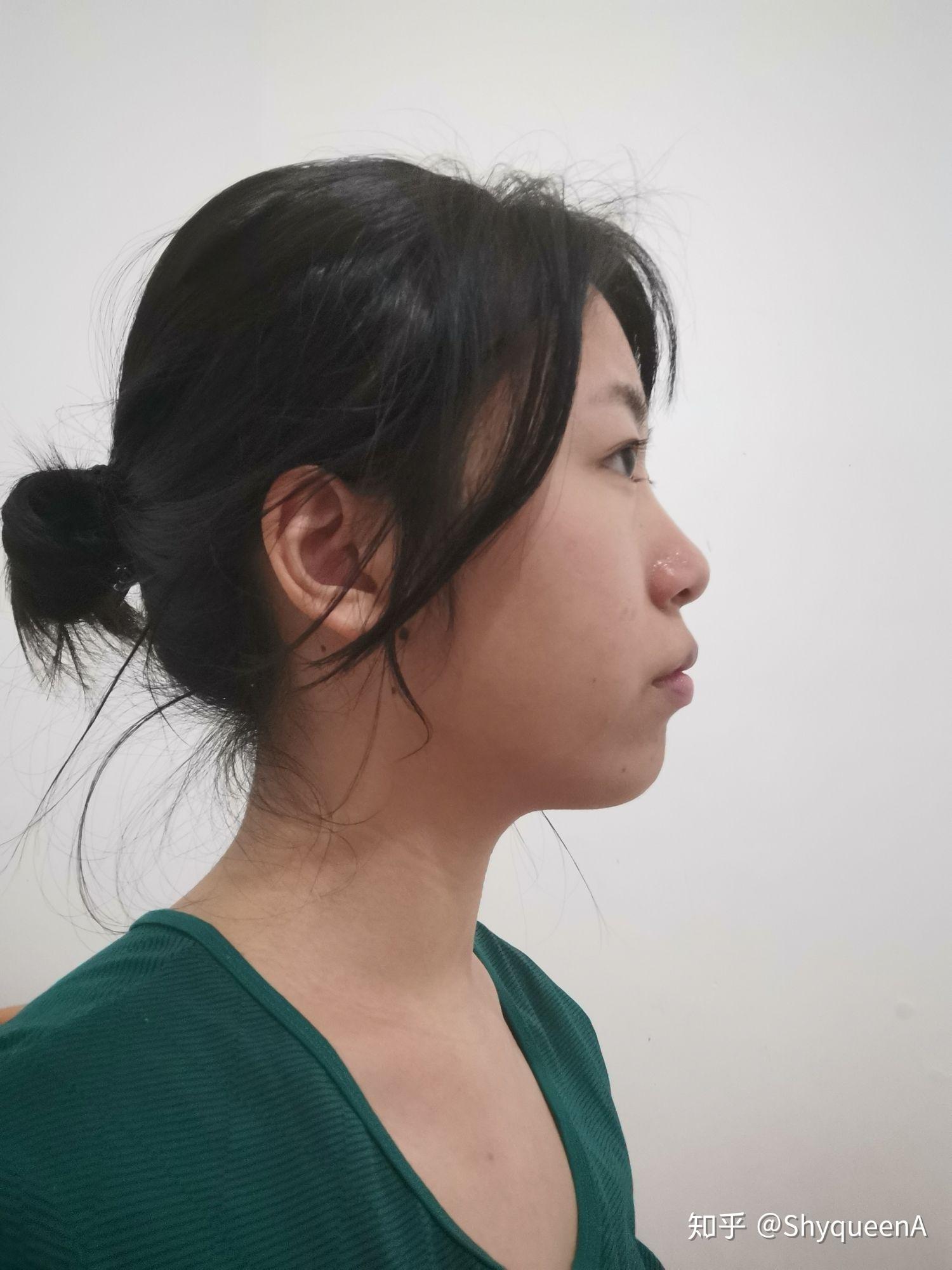 侧脸很平啊 怎么办啊 感觉脸就是一条线下去了 特别丑 眼睛近视还突