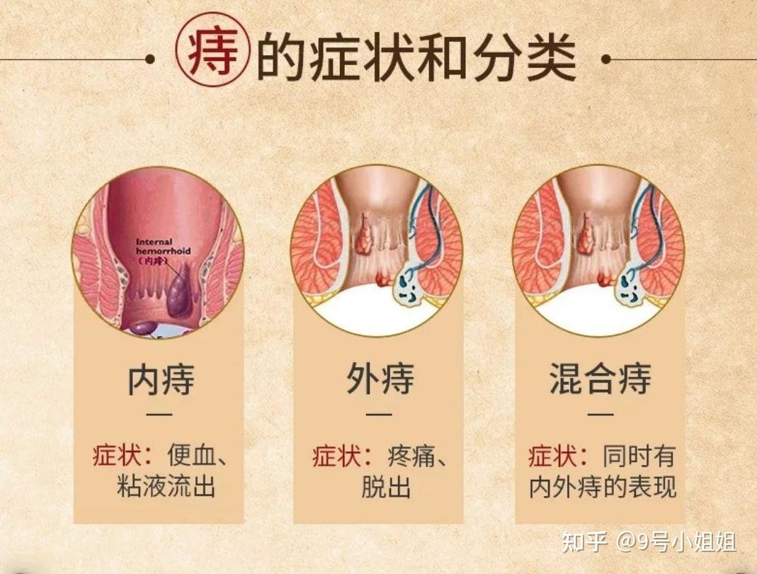 痔疮出血怎么治疗方法