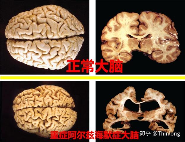 如何预防老年痴呆为什么年轻人也会老年痴呆