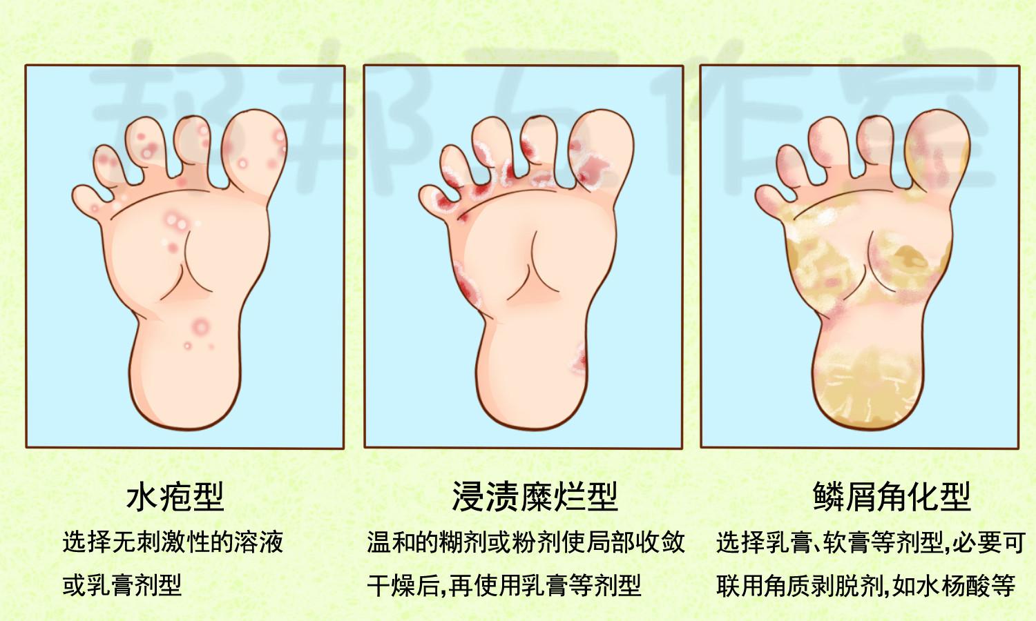 花季少女得脚气了怎么办