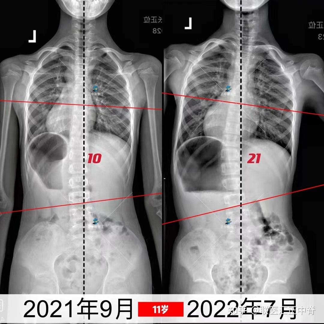 侧弯案例 | 脊柱侧弯治疗的黄金期到底是什么时候? - 知乎