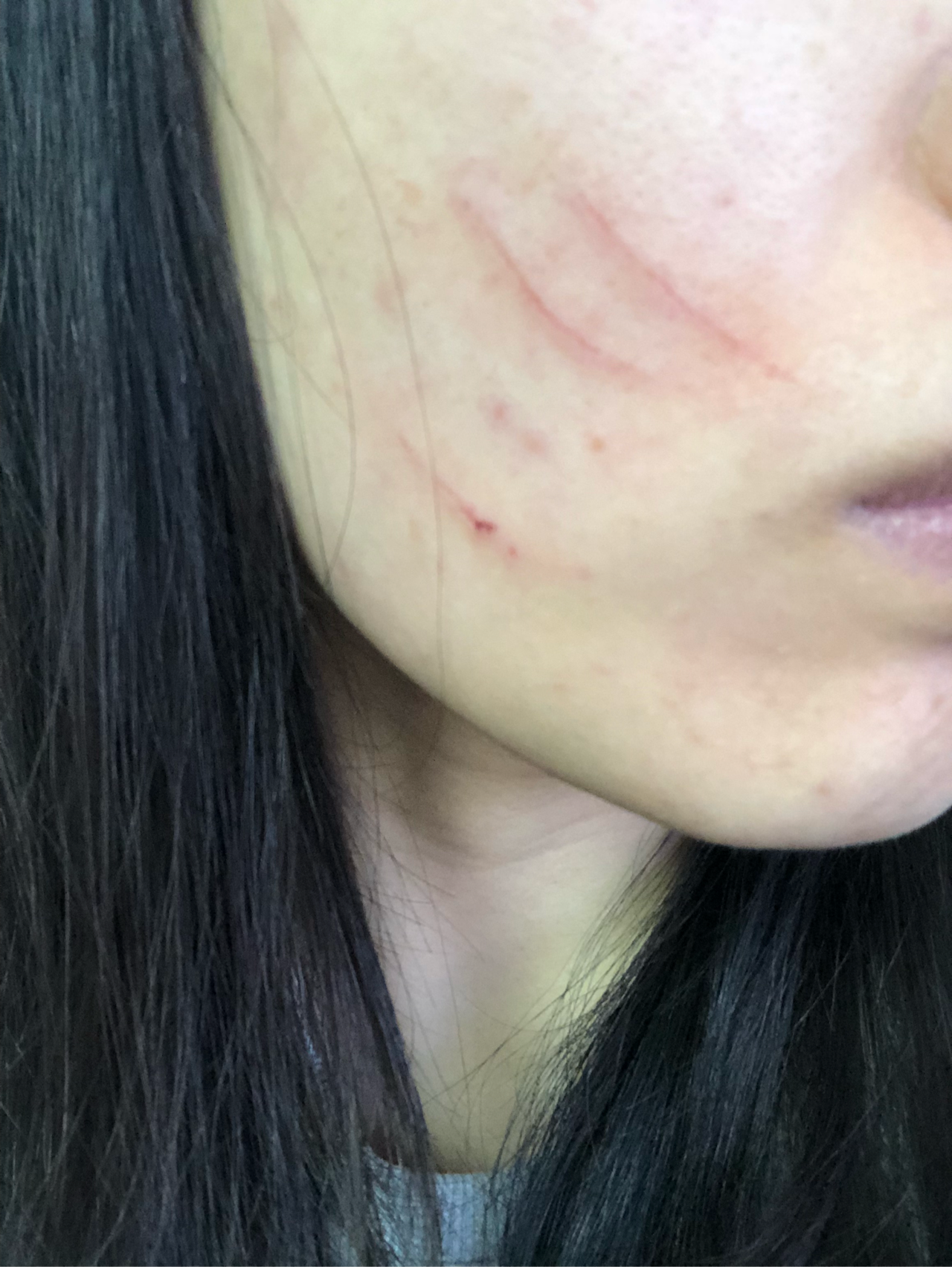 脸被宠物猫抓伤怎么做才能不留疤求指导女生毁容就完蛋了