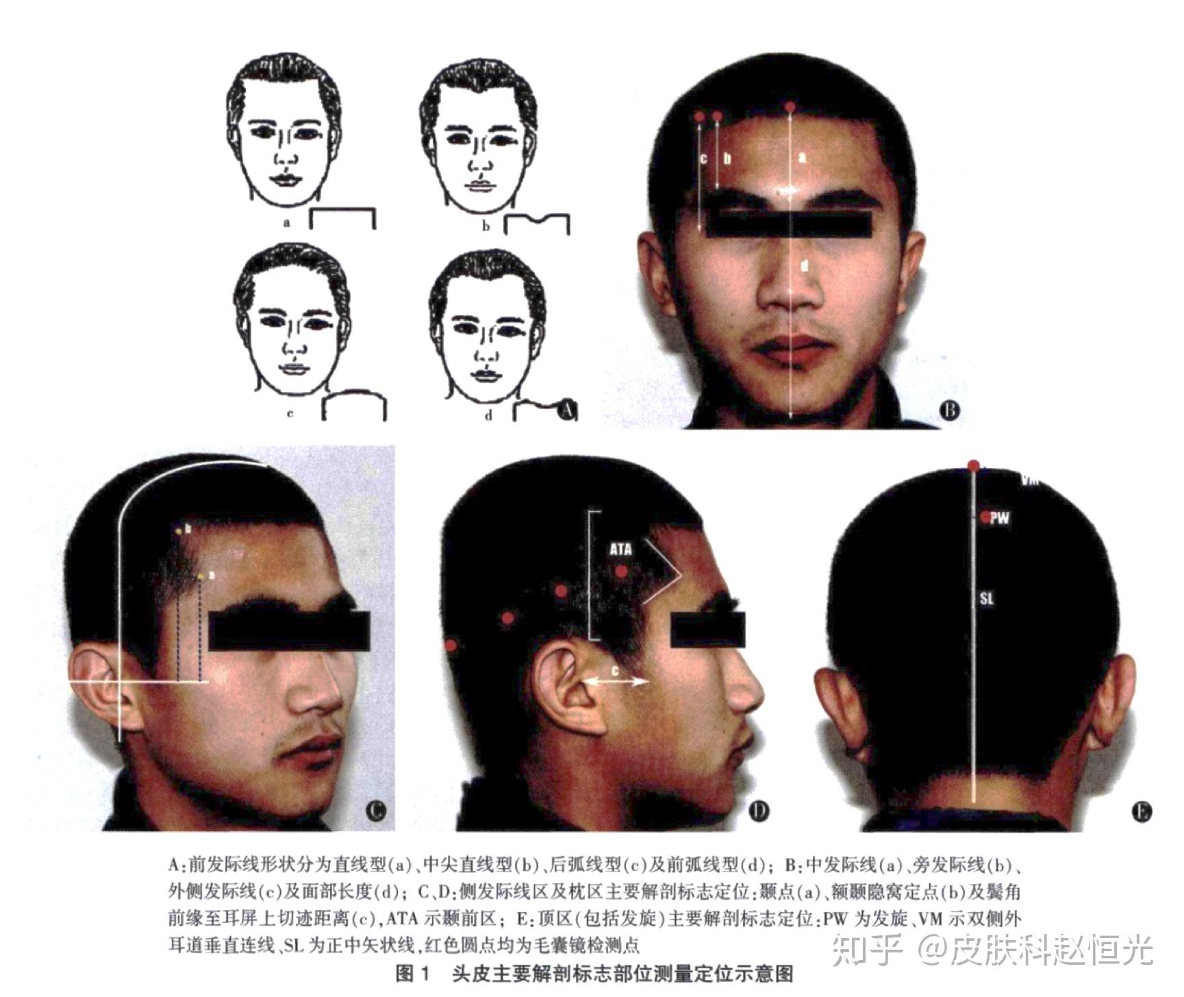 我们头上的头发密度分布是什么样的?头顶密度,后枕部密度和两侧密度?