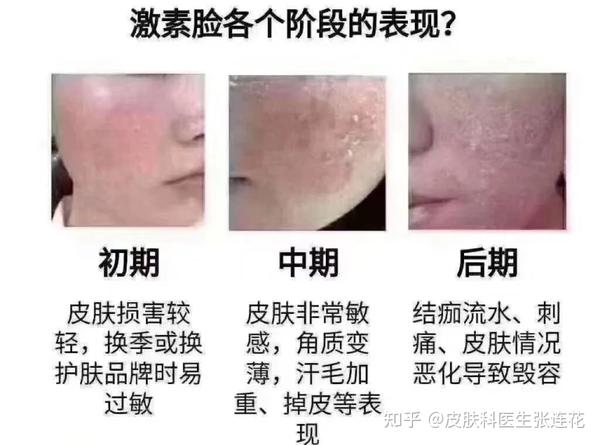 【赣州肤斗士皮肤科】激素脸、脂溢性皮炎、玫瑰痤疮如何区分? - 知乎