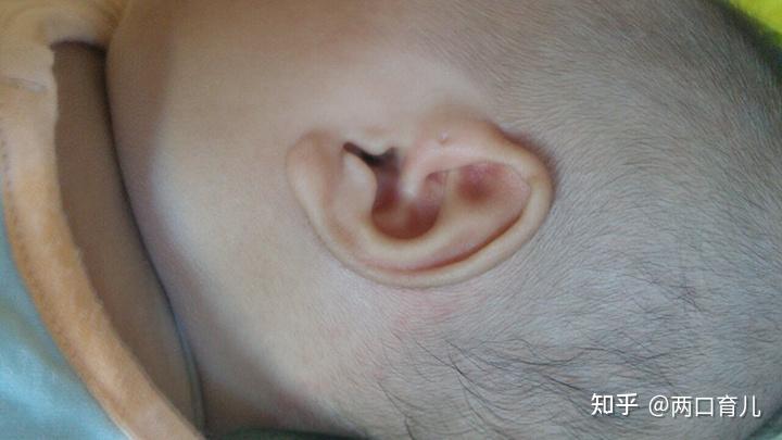 孩子耳朵长小孔是有福气的表现老话不靠谱别把疾病当成福