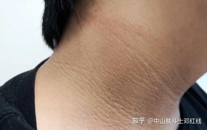 中山肤斗士脖子黑黑的洗不干净当心黑棘皮病