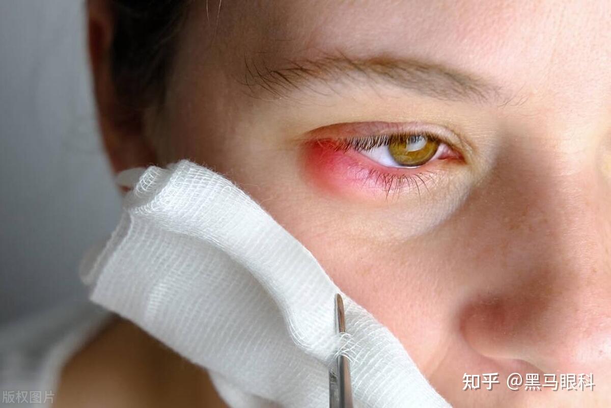又双叒叕长了麦粒肿？ 眼科大夫教你一次搞定 - 知乎