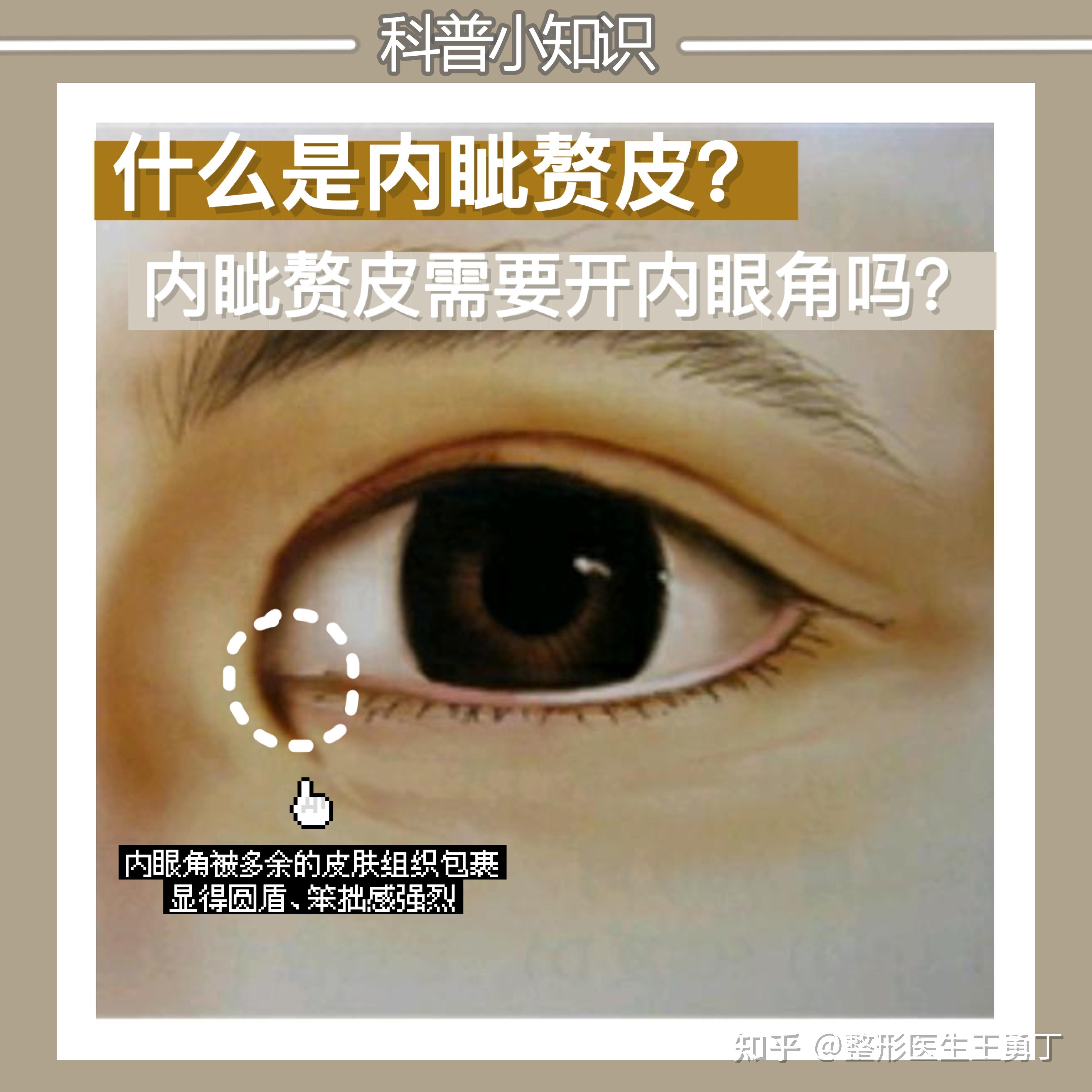 刘亦菲的眼睛有内眦赘皮，为什么她的双眼皮却很好轻度_圈子-新氧美容整形