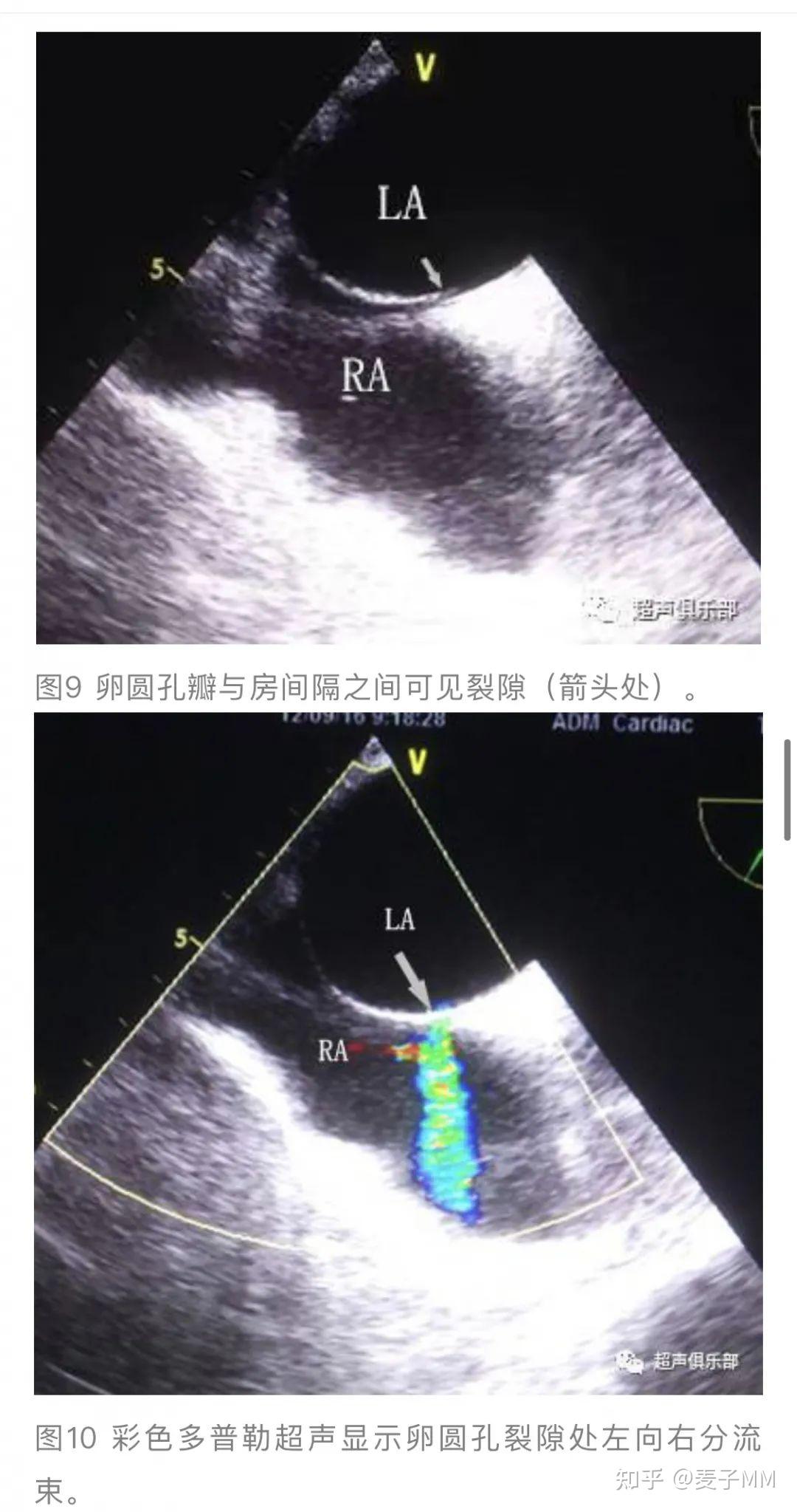 2,经食道超声*房间隔缺损,室间隔缺损都会有心脏杂音,但是卵圆孔未闭