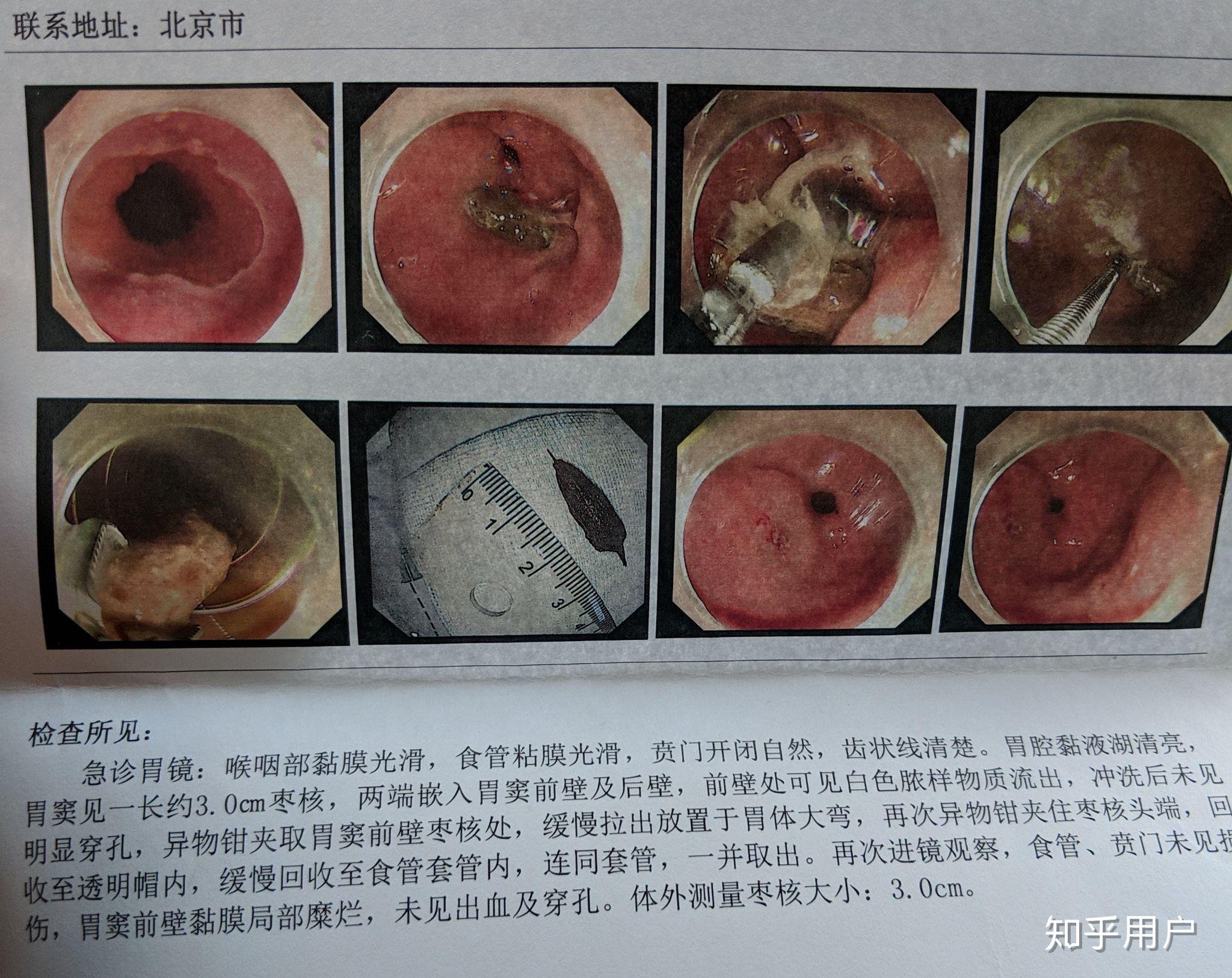 不麻醉做腸鏡或胃鏡是一種什麼樣的體驗