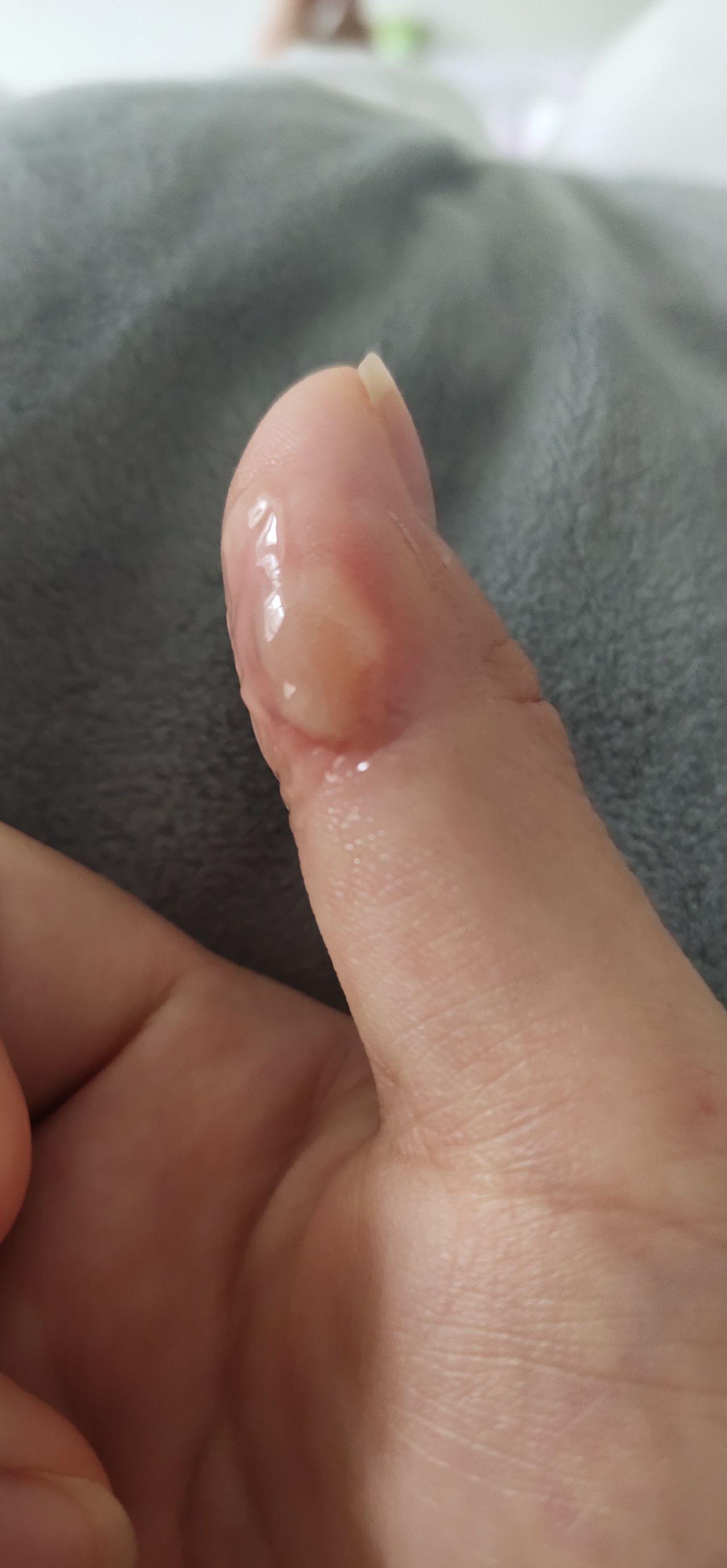 手指被油烫了怎么办? - 知乎