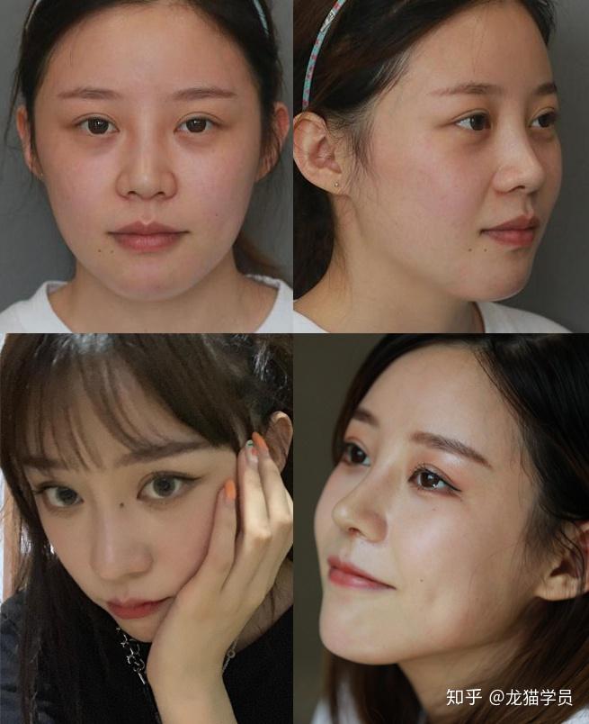 为什么明星整容就算是换头式整容也能整得这么自然而普通人整的基本都