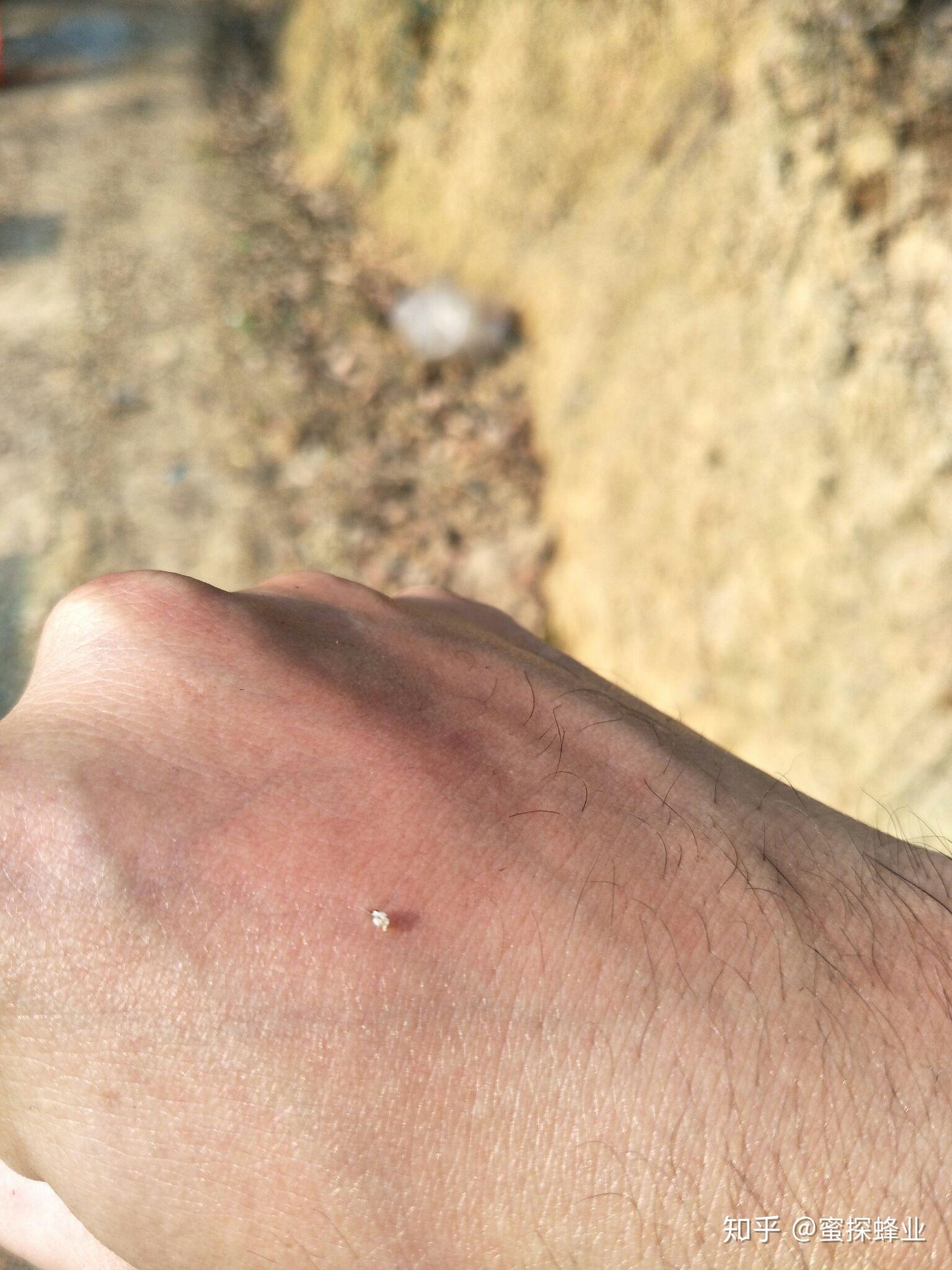 蜜蜂蜇伤毒针要拔出吗? - 知乎