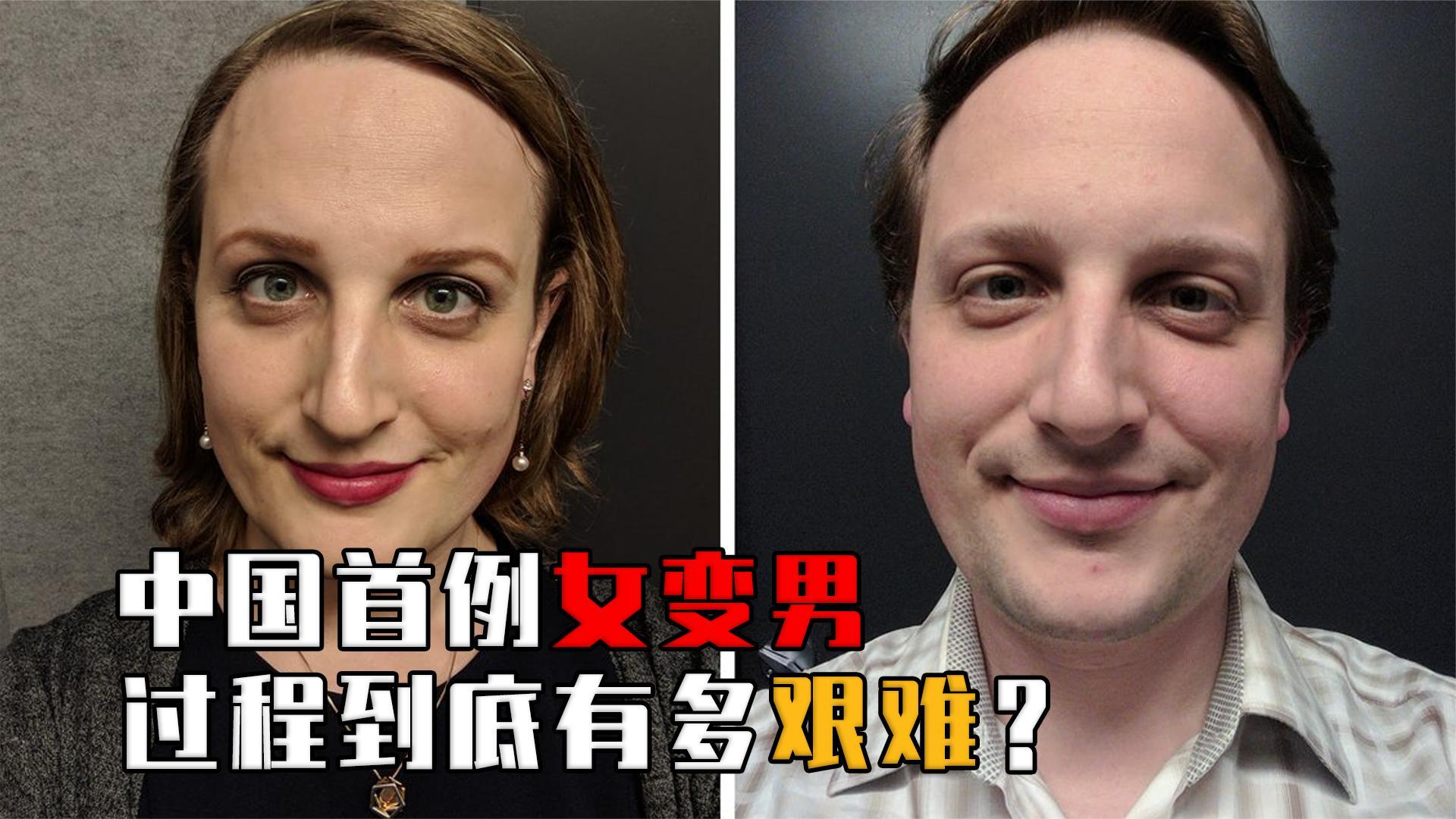 揭秘女变男全过程17年前中国首例女变男变性人后来怎么样了