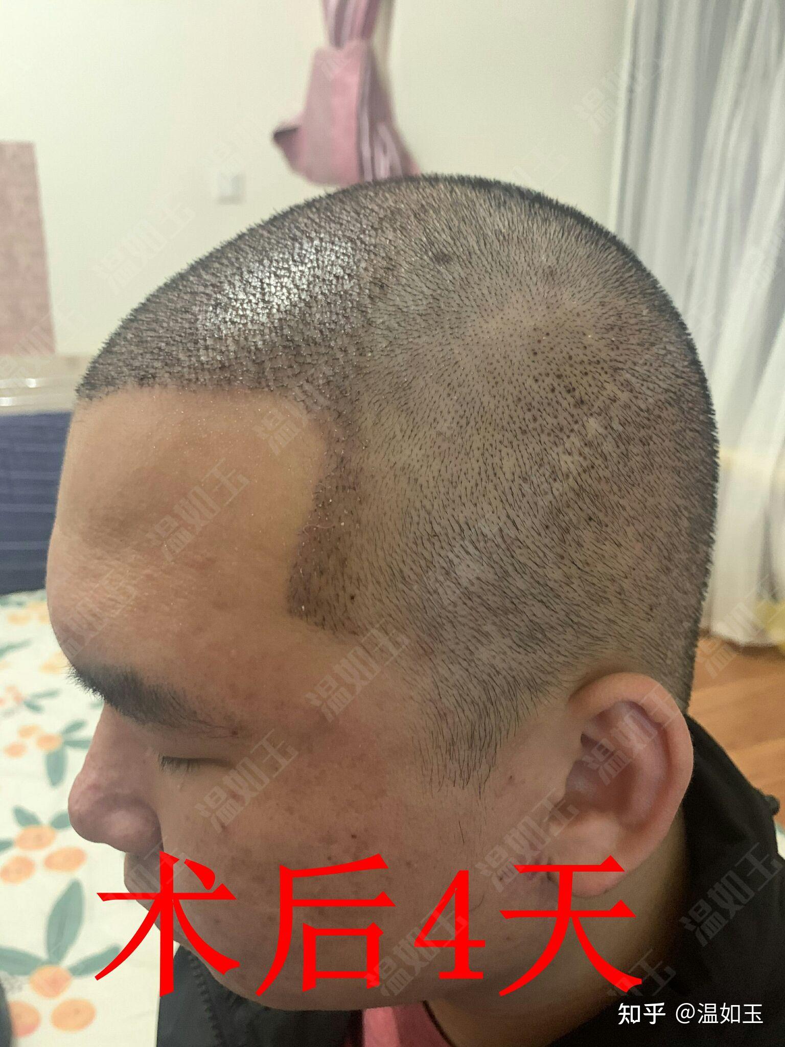阳后做植发(植发后晒晒太阳好吗)