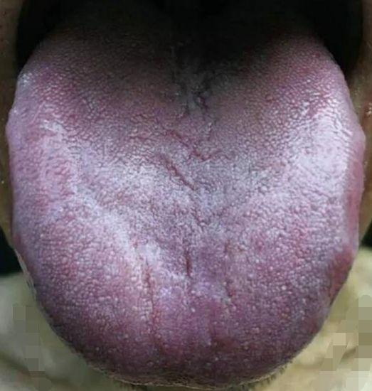 肺癌舌苔图片