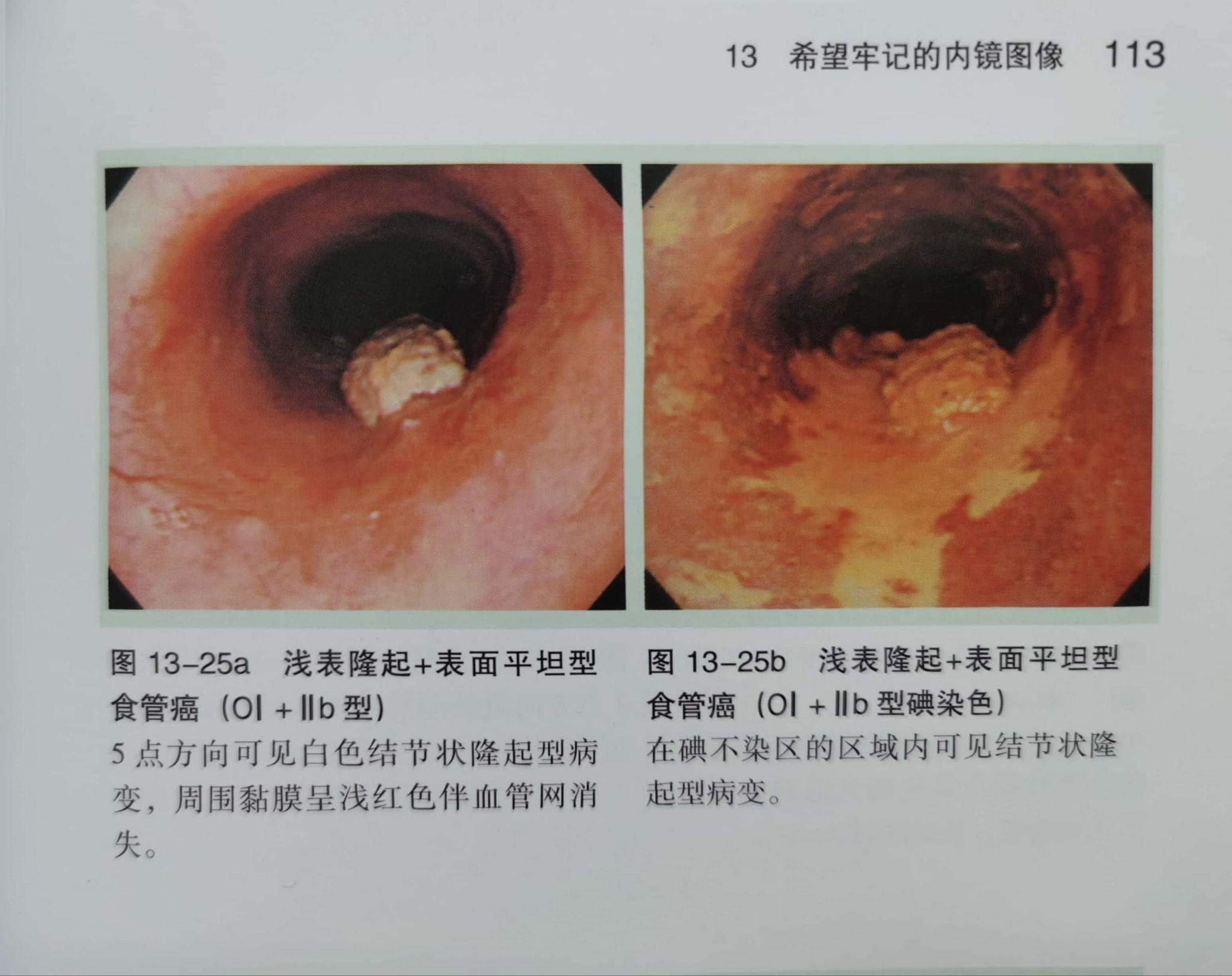 早期食管癌的白光内镜下形态可分为3种类型(图谱)
