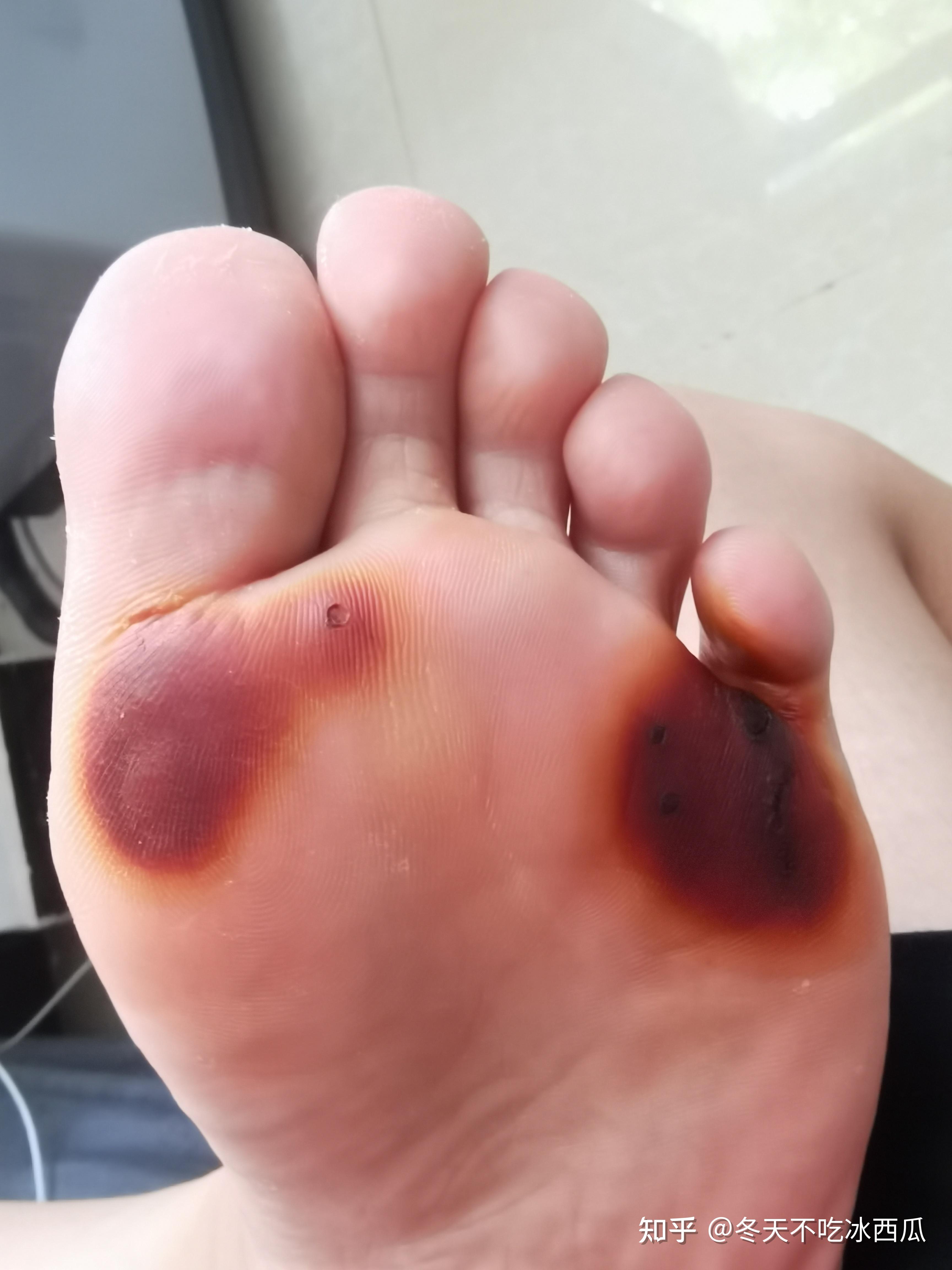 记录我的激光祛跖疣过程