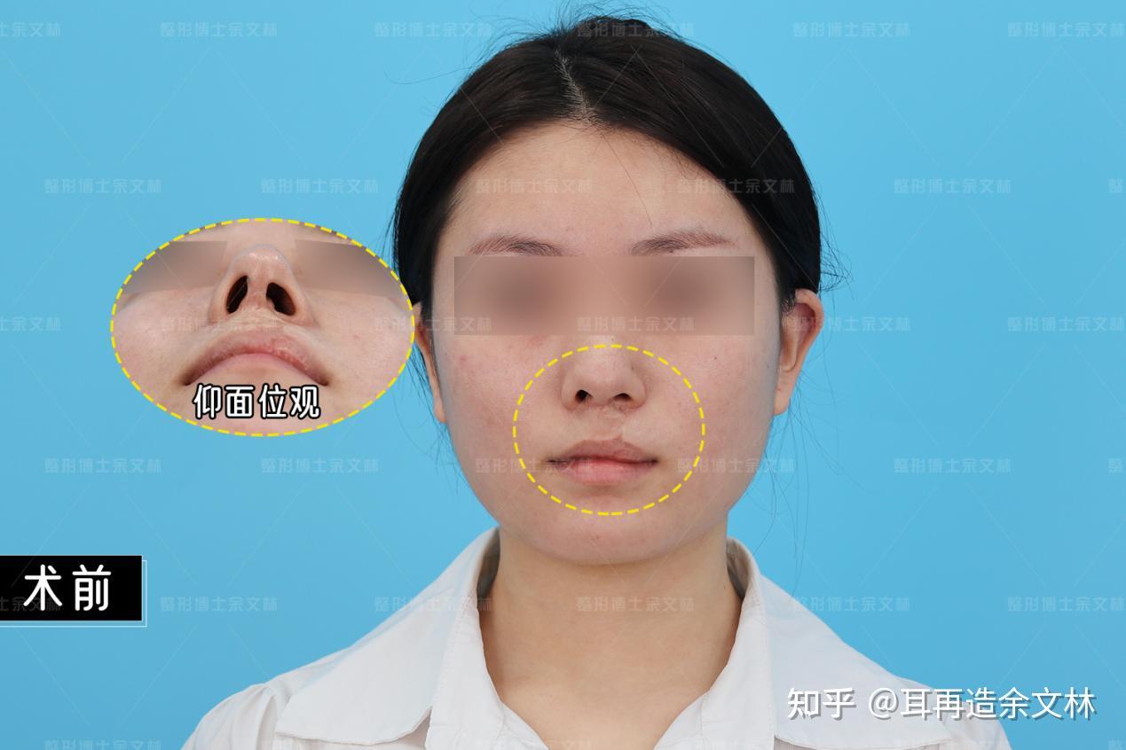【凸嘴、鼻小柱基底凹陷、鼻唇角的改善方法】整形医生蒋立分享 - 知乎