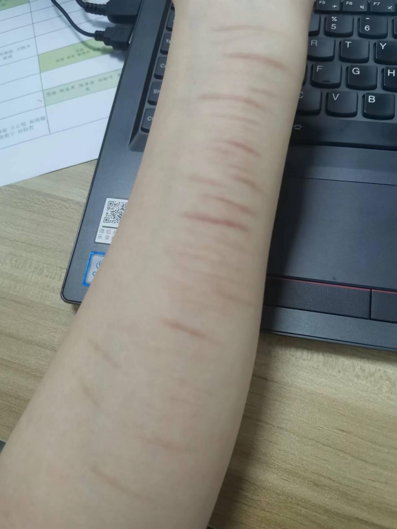 抑郁症患者夏天穿短袖自残痕迹直接露出他心理是怎么想的