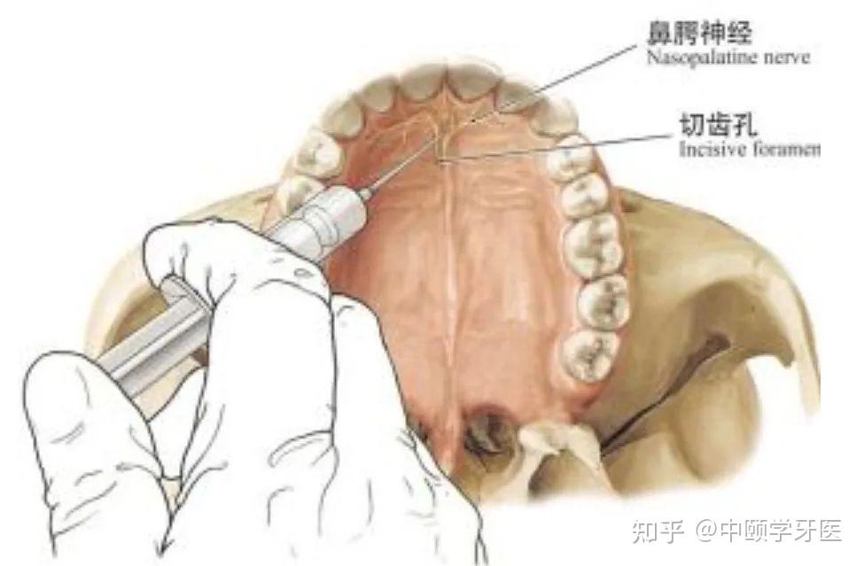 口腔局部阻滞麻醉方法:上颌神经及其分支阻滞麻醉 - 知乎