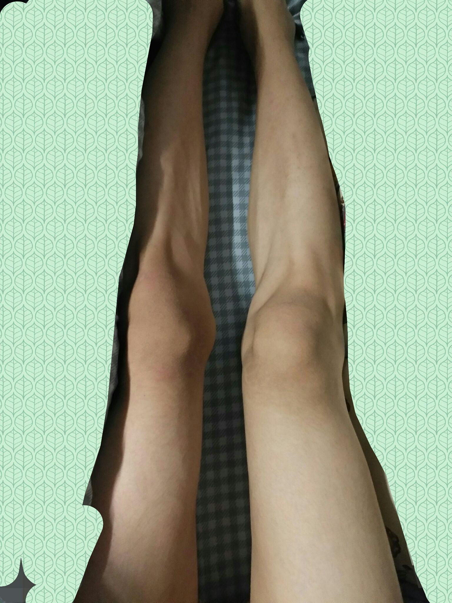 有图啦这样的腿型怎么矫正女孩子膝盖内突很厉害