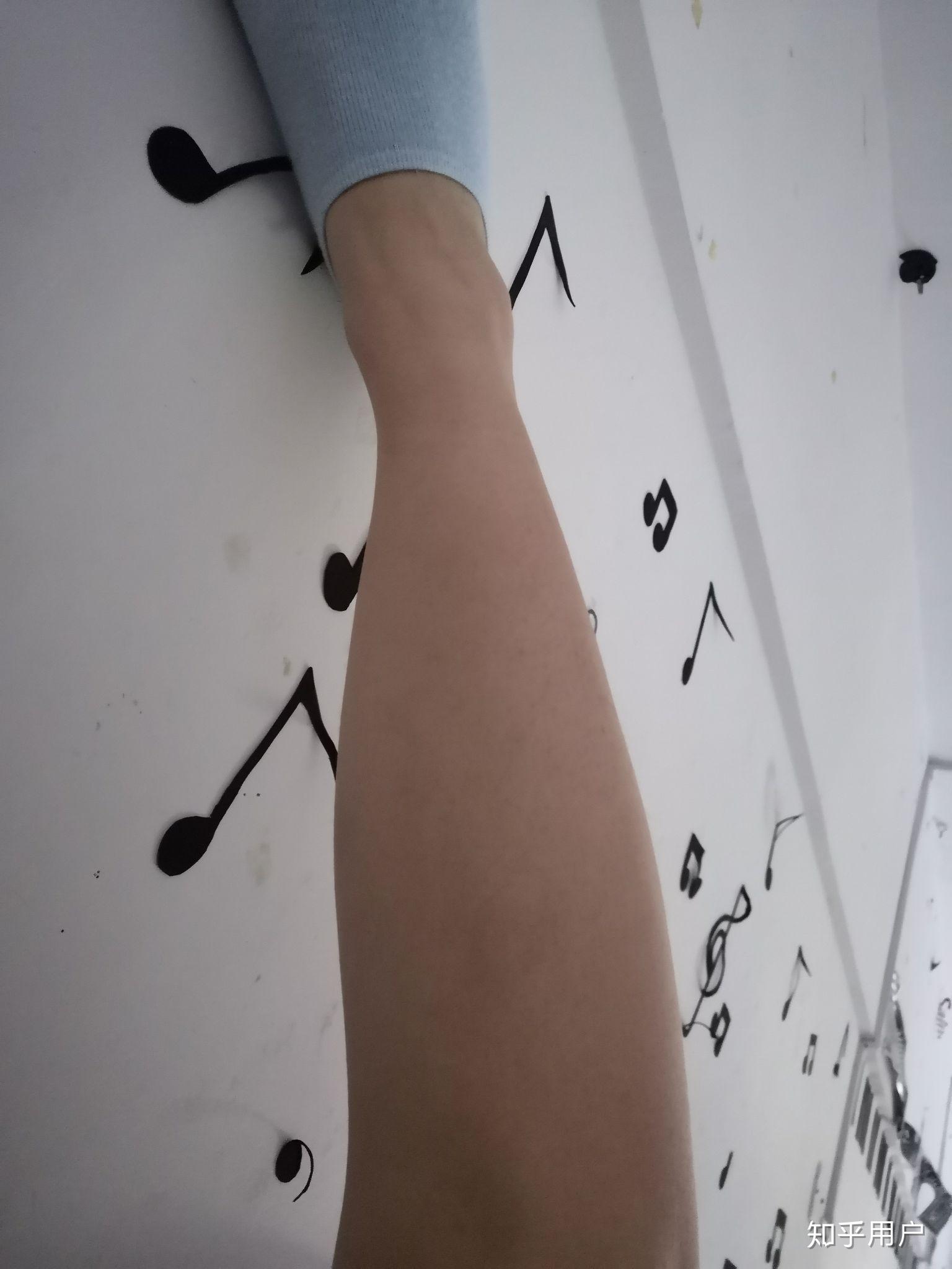 跟腱短小腿粗没有脚脖子怎么办