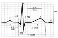 心电图t波改变 - 知乎
