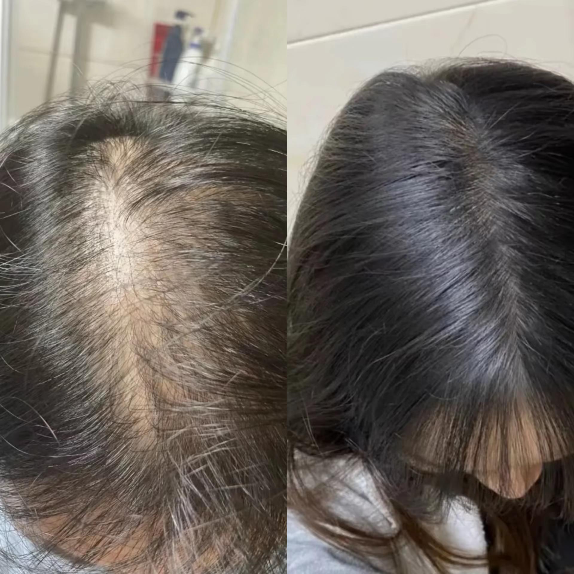 女性脱发怎么办?发量少如何变密?