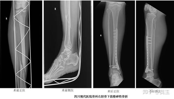 右胫骨下段粉碎性骨折 右胫骨上段粉碎性骨折 蝶秀网