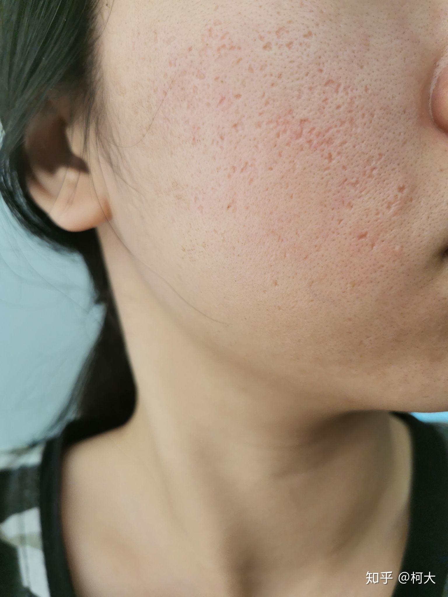 激光祛痘坑真实记录