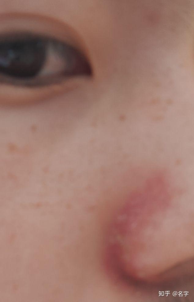 脂溢性皮炎引起的鼻侧发红掉皮瘙痒该如何处理