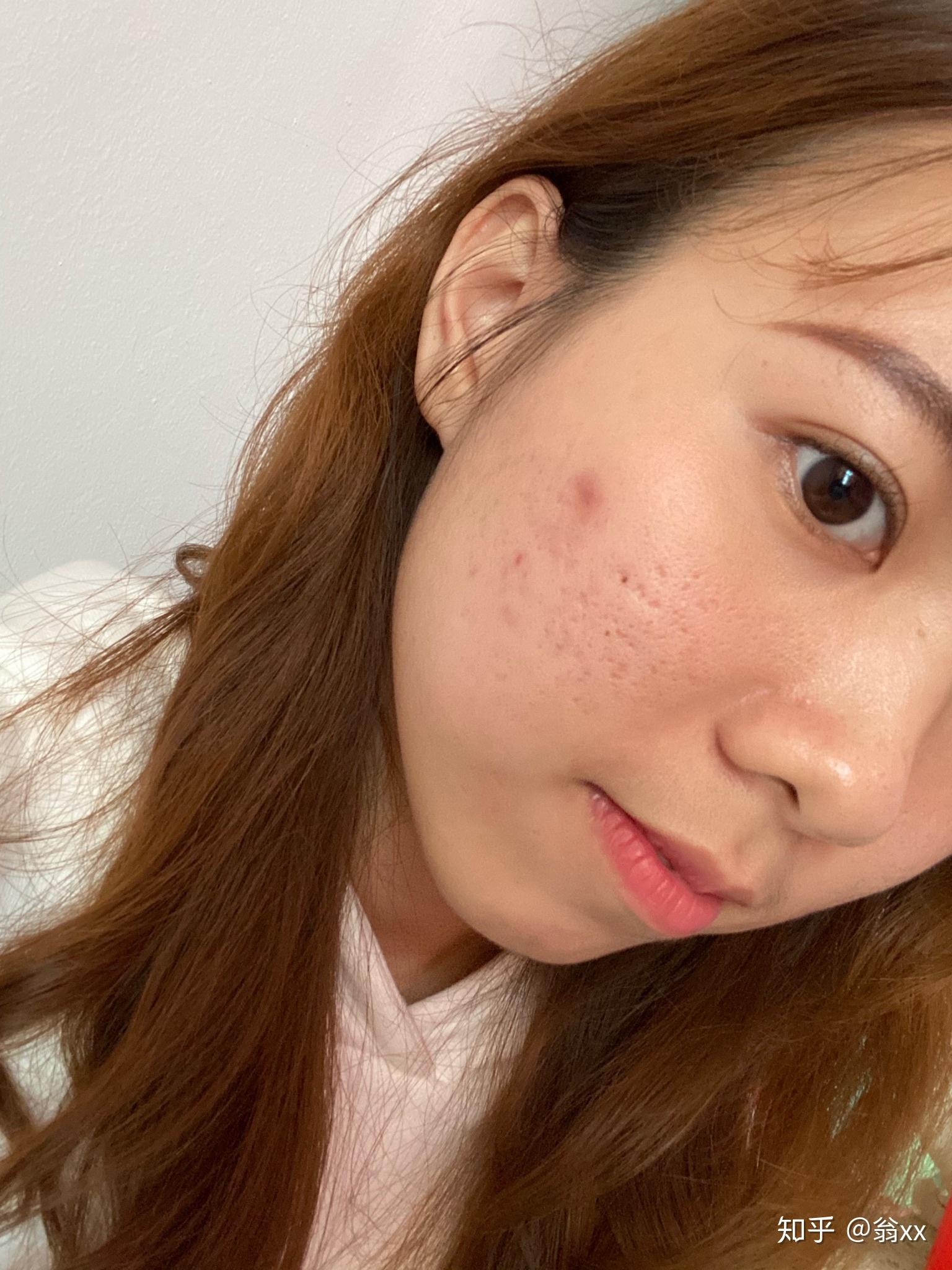 你们的痘印痘坑都是怎么好起来的? - 知乎