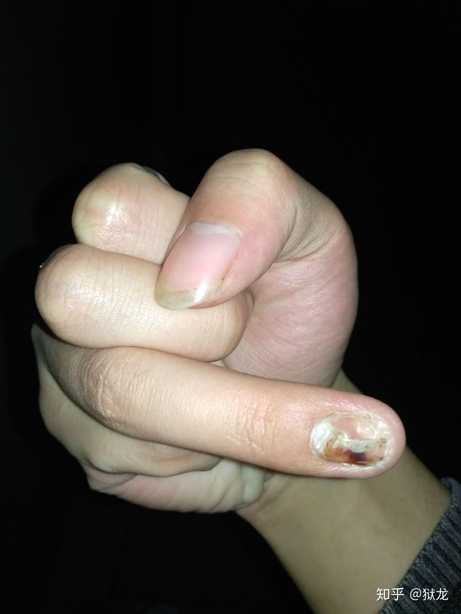 手指甲被夹到,过了一段时间,有黑色的淤血,怎么处理? 